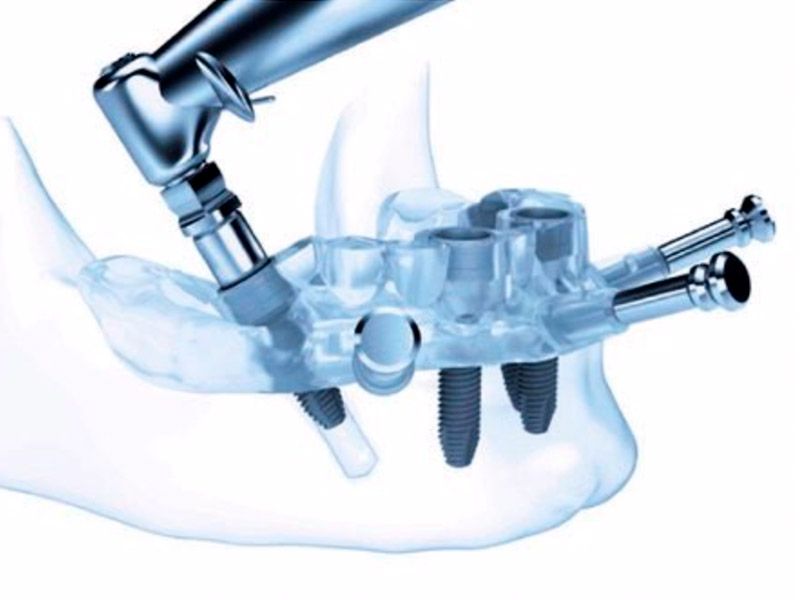 Cirugía guiada implantes | Clínica Dental Blanc