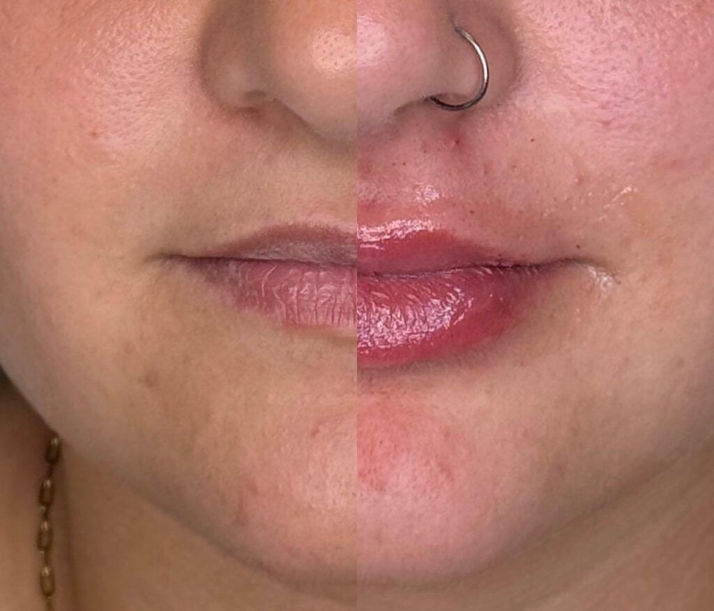Augment Llavis Pineda de Mar | Clínica Dental Blanc