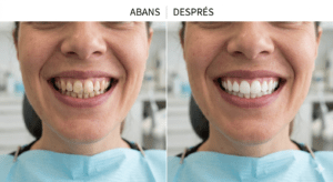 Blanquejament dental a Pineda de Mar