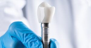 Precio Implante Dental Pineda de Mar | Clínica Dental Blanc